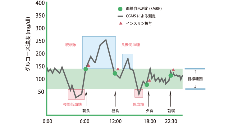 CGM表